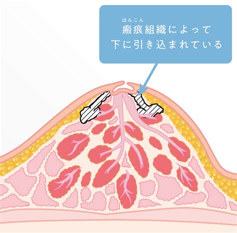 仮性陥没乳首|陥没乳首（陥没乳首）の3つの陥没例を解説!片方だけ陥没してい。